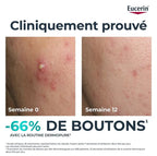 Eucerin DERMOPURE CLINICAL TRIPLE ACTION Peau grasse à tendance acnéique